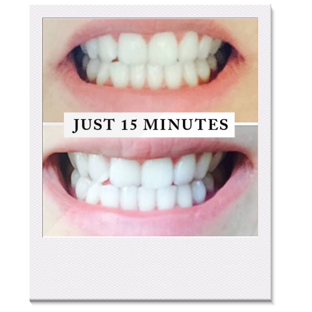 Teeth Whitening Kit 10PCS/6pcs/4pcs